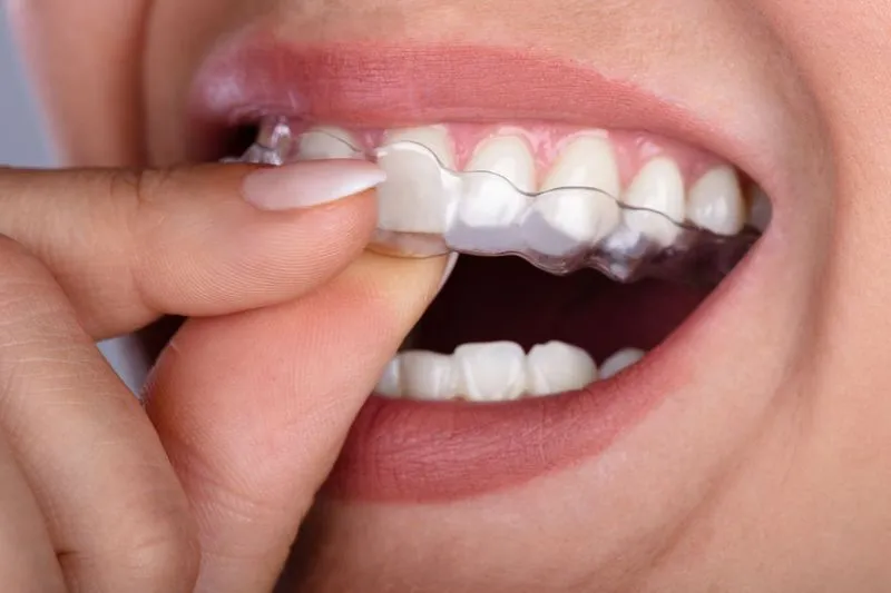 clear aligners