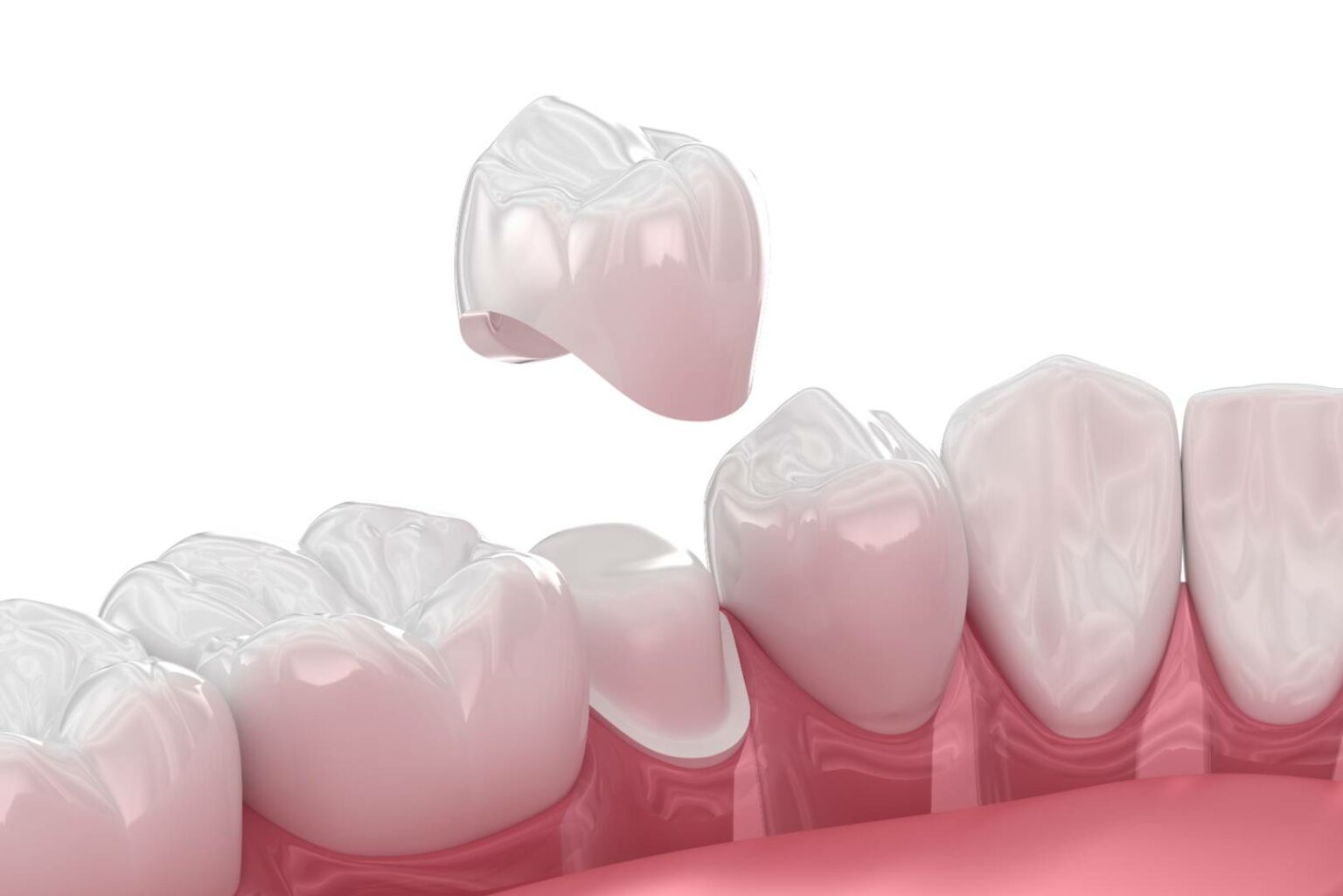 Porcelain Crowns Sugarloaf Signature Dentistry