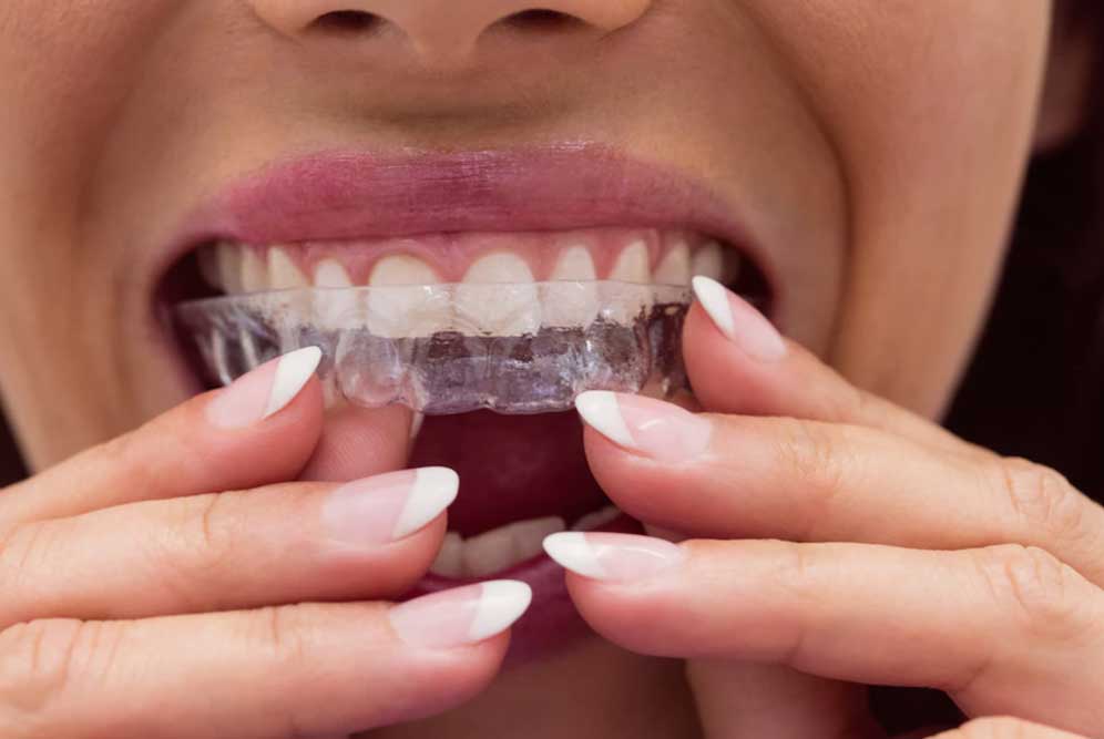 putting on clear aligners