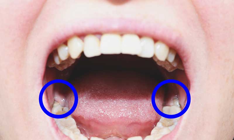 A visual representation of impacted wisdom teeth before the oral surgery.
