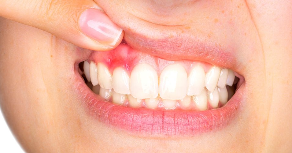 A girl with gingivitis and periodontal disease has swollen gums.