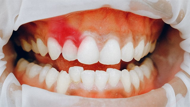 A patient with severe gingivitis and swollen gums at the dentist's office for gum disease treatment.