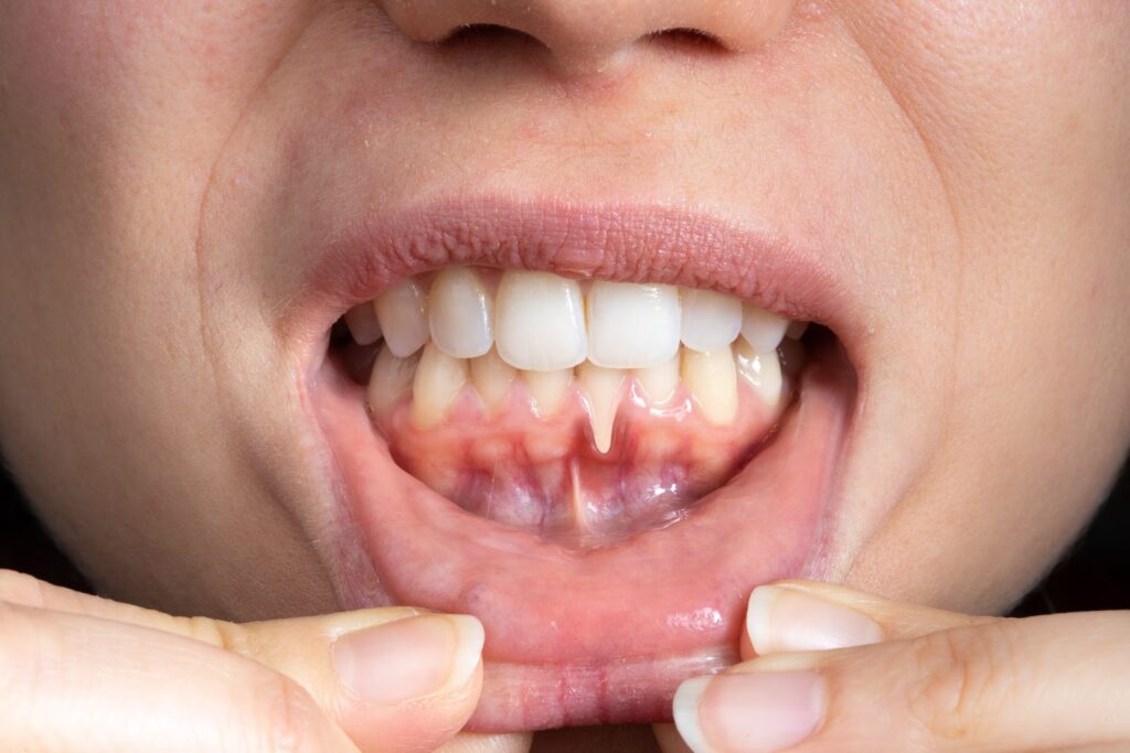 A woman with gingivitis and a periodontist getting examined for gum disease at a dentist's office.