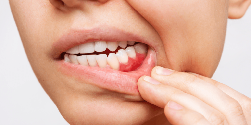 Close-up of inflamed gums indicating gingivitis, requiring periodontics and gum disease treatment.