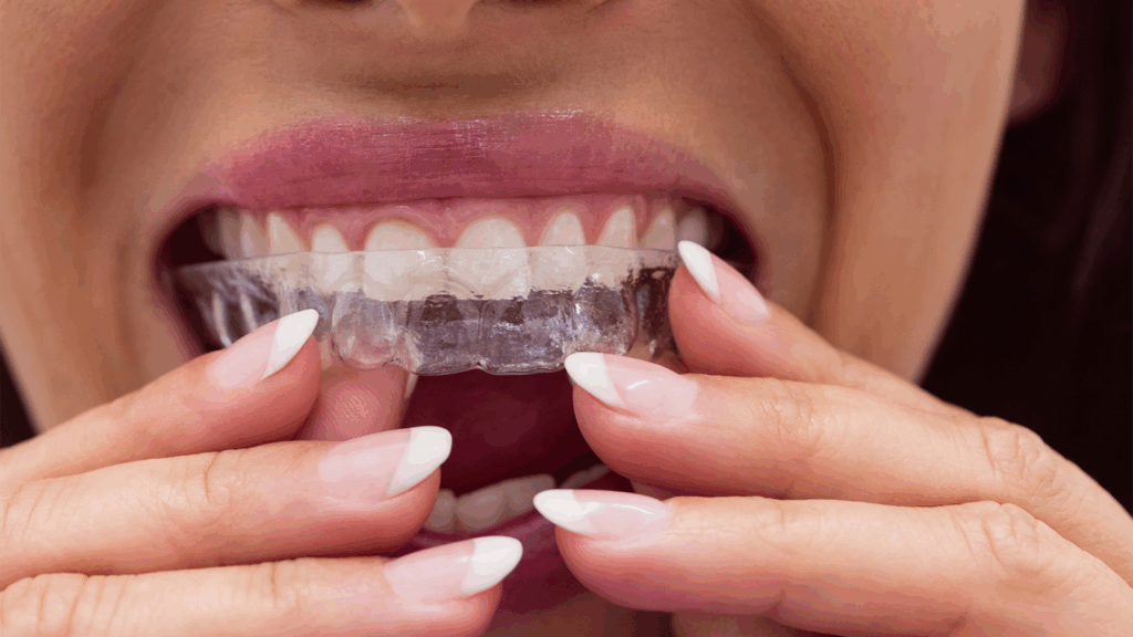 A close-up of a woman inserting Invisalign clear aligners, a discreet alternative to metal braces and traditional clear braces.