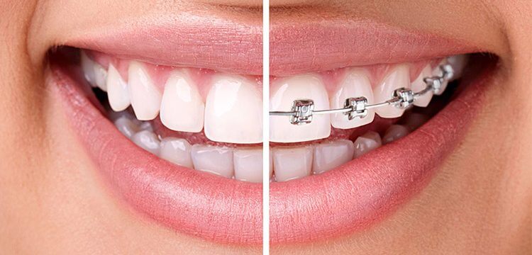 A split-image compares Invisalign and braces, showcasing Invisalign's cost, price, and whether it's cheaper than braces.