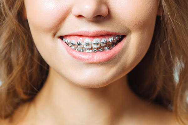 The girl at the expert orthodontics care near her for the best results.