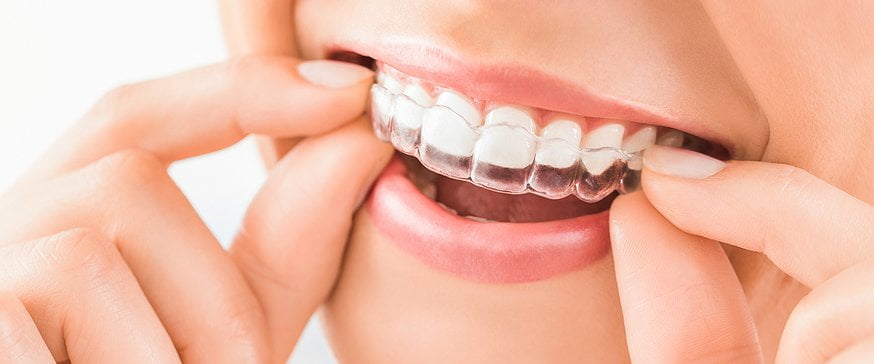 A person inserting Invisalign aligners compares Invisalign vs braces and how long Invisalign takes.