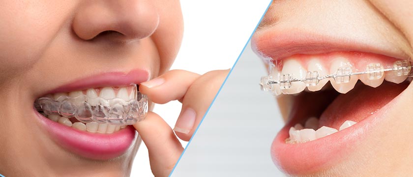 Side-by-side comparison of Invisalign vs braces, highlighting differences in appearance.