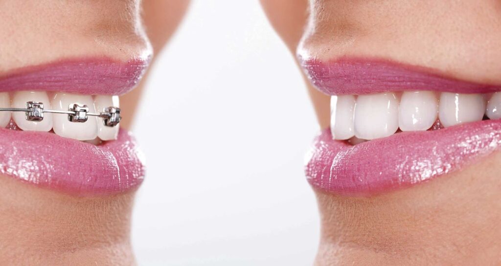 Side-by-side comparison of traditional Invisalign vs braces results, highlighting treatment effectiveness and aesthetics.